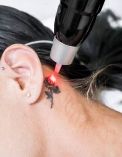 Laser tattoo removal treatment session on patient, using picosecond technology, to break down tattoo ink into smaller particles. At a beauty and skincare clinic for aesthetic lasers.